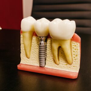 Dental implants with screw on table in clinic