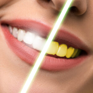 teeth whitening