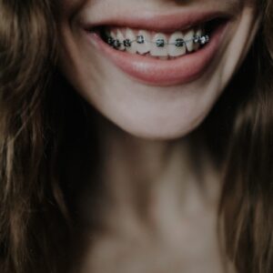 woman smiling and demonstrating teeth braces