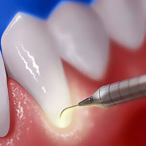 Laser dentistry