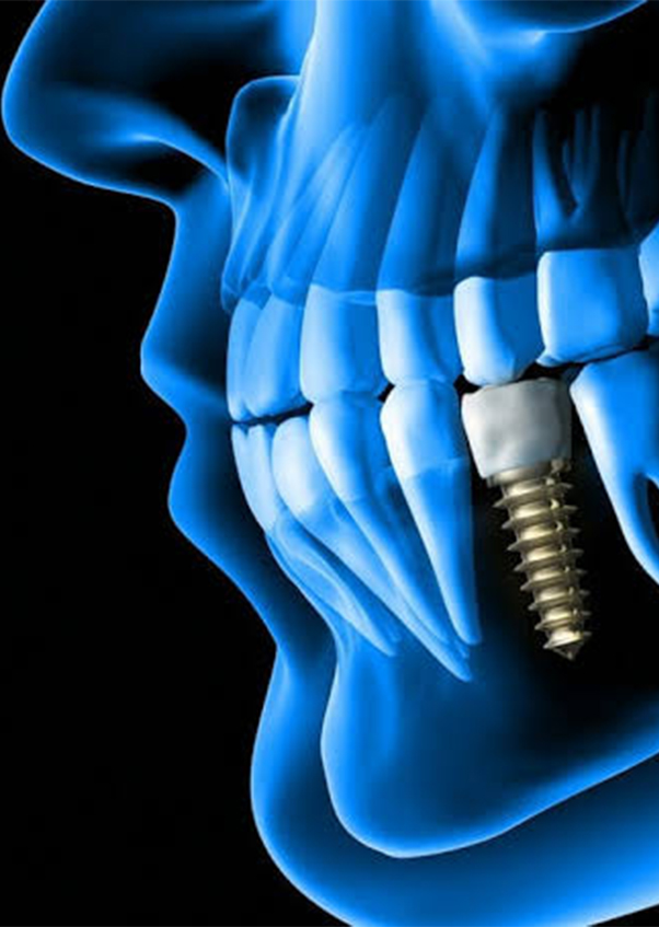 dental implants